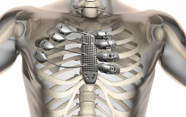 بیماران یک استرنم تیتانیوم و قفسه ی سینه ی چاپ سه بعدی دریافت میکنند .