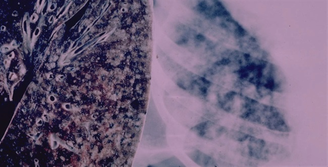 تشخیص سرطان از راه تنفس