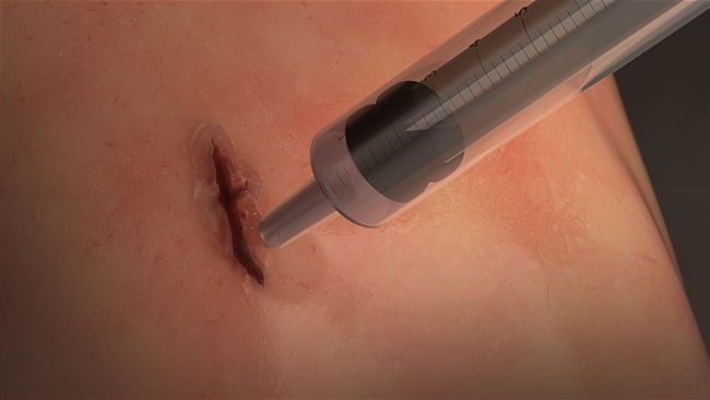 محققان چسب جراحی سریعی را برای بستن زخم تولید کردند