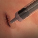 محققان چسب جراحی سریعی را برای بستن زخم تولید کردند