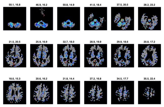نرم افزار Darmiyan، مراحل اولیه‌ی آلزایمر را تشخیص می‌دهد