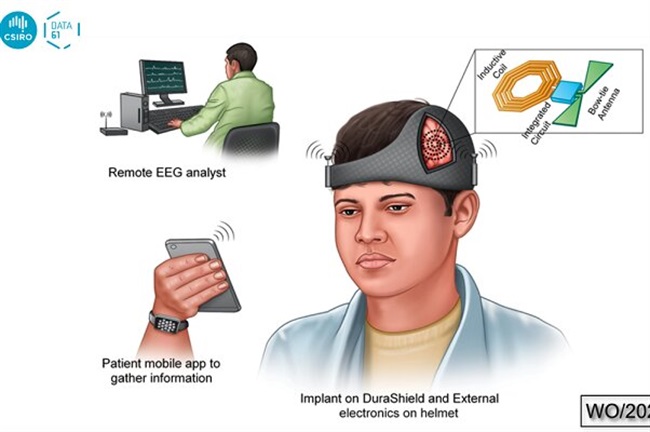 کلاه هوشمند از تشنج مغزی بعد از جراحی جلوگیری می‌کند